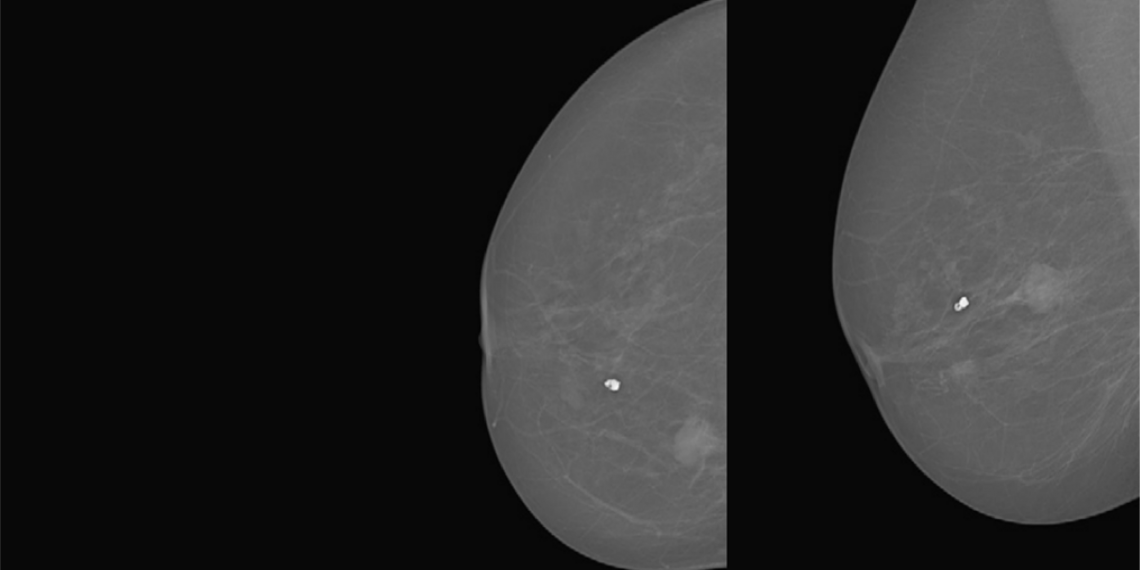 DR: INbreast:Toward a Full-field Digital Mammographic Database