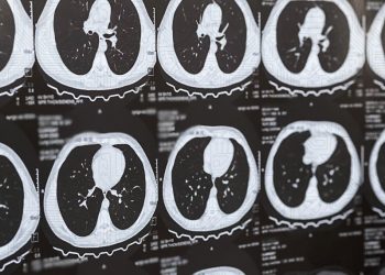 Há novas ferramentas de IA para gerar dados sintéticos no diagnóstico do cancro do pulmão e o INESC TEC está a desenvolvê-las