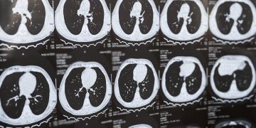 Há novas ferramentas de IA para gerar dados sintéticos no diagnóstico do cancro do pulmão e o INESC TEC está a desenvolvê-las